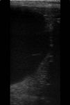 černá oblast je část dělohy naplněné hnisem (pyometra) na obrázku z ultrazvuku